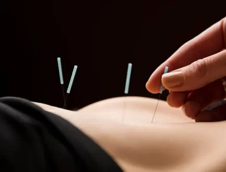 Acupuncture Needling